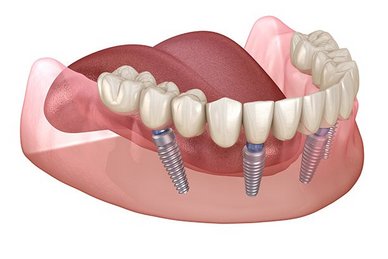All-on-4-Visualisierung Unterkiefer