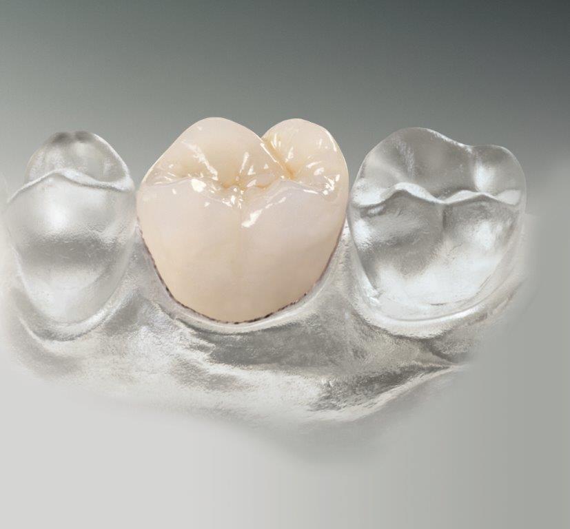 Krone neben zwei durchsichtigen Kunstzähnen