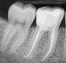 Endodontie Zahnwurzel gute Prognose AllDent