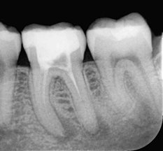 Endodontie Zahnwurzel schlechte Prognose AllDent